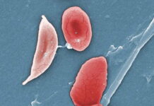 Globule rouge falciforme (pâle, à gauche), typique de la maladie Drepanocytose
