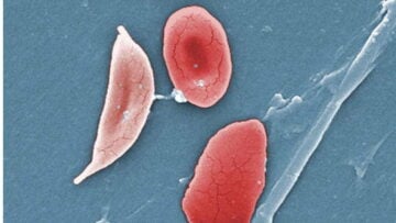 Globule rouge falciforme (pâle, à gauche), typique de la maladie Drepanocytose