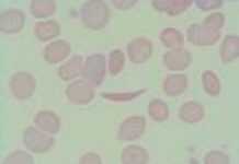 Congo : clôture des premiers états généraux mondiaux de la drépanocytose Congo : clôture des premiers états généraux mondiaux de la drépanocytose