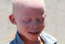 Enfant albinos