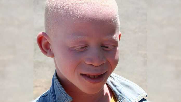 Enfant albinos