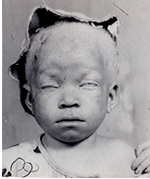 Enfant albinos