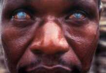 La cécité des rivières peut être éliminée Onchocercose, ou la cécité des rivières © Pak Sang Lee