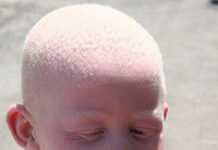 Les albinos toujours la cible de meurtres rituels en Afrique de l’Est