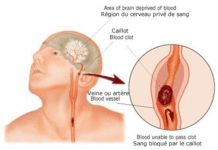 AVC : les femmes plus exposées que les hommes ! AVC : les femmes plus exposées que les hommes !