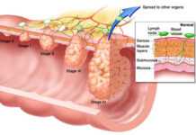 Cancer colorectal : ces malades que l’aspirine ne protège pas !