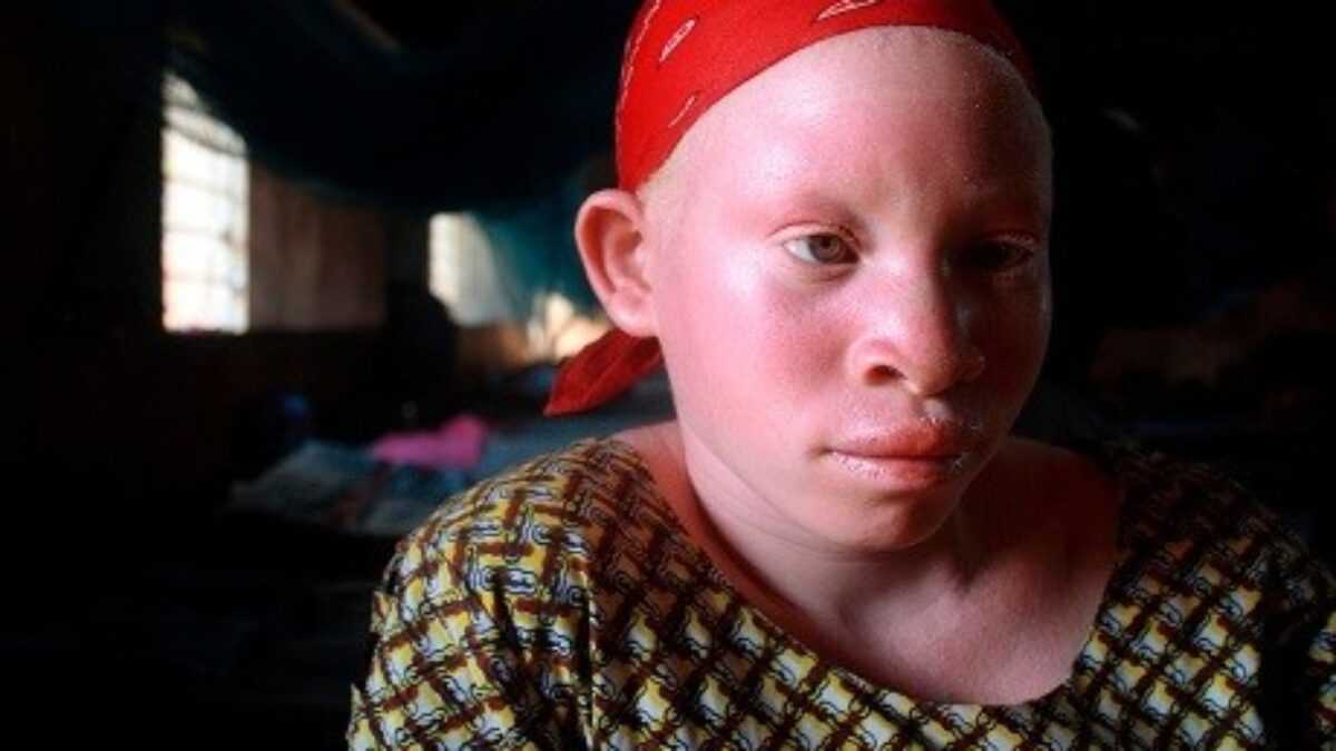 enl-vement-d-albinos-en-tanzanie-l-onu-pr-occup-e