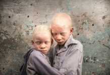 Afrique de l’Est : augmentation des crimes commis contre les albinos, selon l’ONU