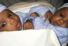 Guinée : des bébés siamois séparés avec succès à l’hôpital Necker en France