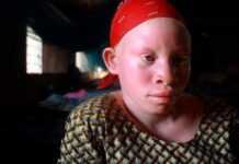 Tollé au Mali après la décapitation d’un enfant albinos dans un meurtre rituel Tollé au Mali après la décapitation d’un enfant albinos dans un meurtre rituel