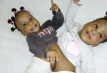 Cameroun : deux petites siamoises opérées à l’hôpital Mère-Enfant en France