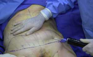 1200px Fat removal using cannula during tumescent liposuction