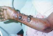 Mauritanie: un premier cas de fièvre Crimée-Congo Mauritanie: un premier cas de fièvre Crimée-Congo