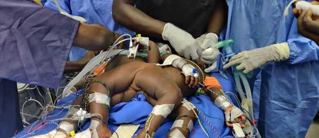 Ouganda : séparation chirurgicale réussie des jumeaux siamois