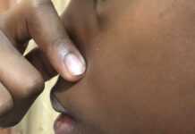 Ne vous pincez plus le nez, éternuez à souhait ! Nez pincé (07 oct 21)