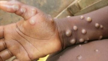 Sénégal : la fièvre de la Vallée du Rift gagne du terrain, le Mpox sous étroite surveillance La variole du singe
