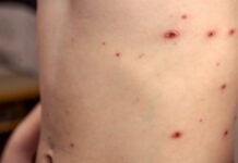 Trois cas suspects de variole du singe découverts au Maroc Variole du singe