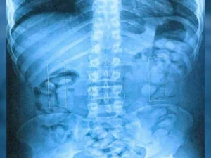 La radiographie montre des dizaines de capsules avalées par l'un des passeurs de drogue liés au même réseau de trafic